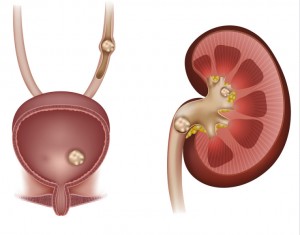 Stones in the kidney urinary bladder and ureter. Detailed anatomy illustration of the kidney cross section and urinary bladder cross section